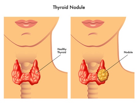 Byetta Thyroid Cancer