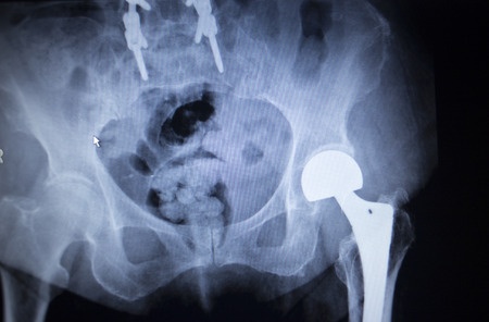 DePuy Hip Replacement Lawsuit