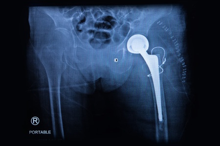 DePuy Hip Replacement