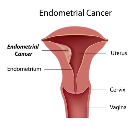 Endometrial Stromal Sarcoma