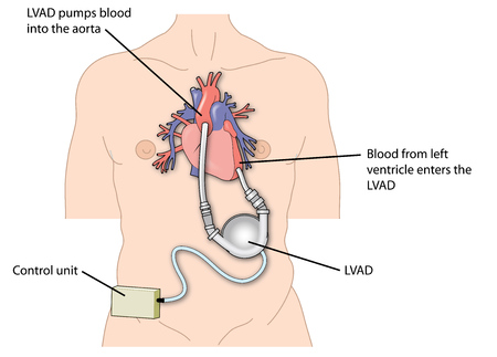 Heartware Ventricular Assist Device Recall