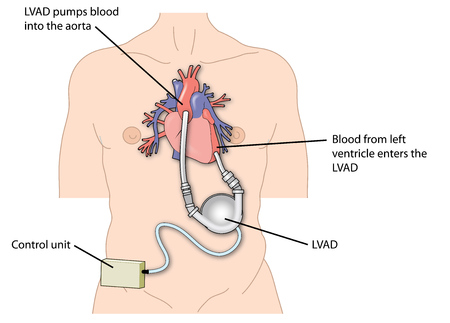 Heartware Ventricular Assist Device