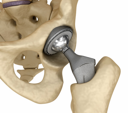 Hip Replacement Class Action