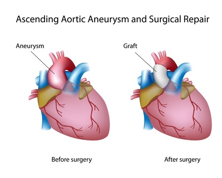 Levaquin Aortic Aneurysm