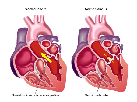 Levaquin Aortic Dissection