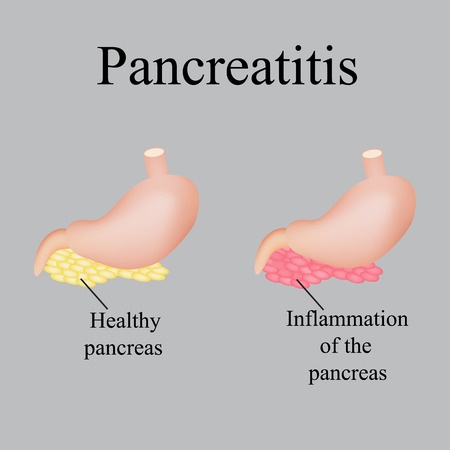 Nesina Pancreatitis
