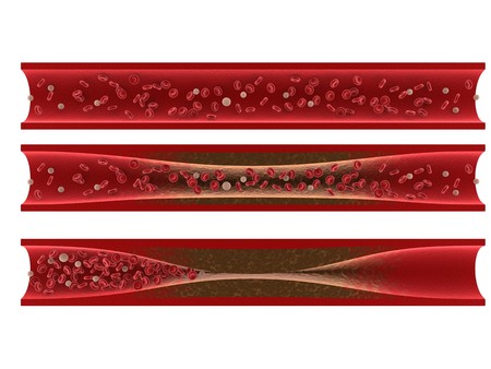 Tasigna Arteriosclerosis