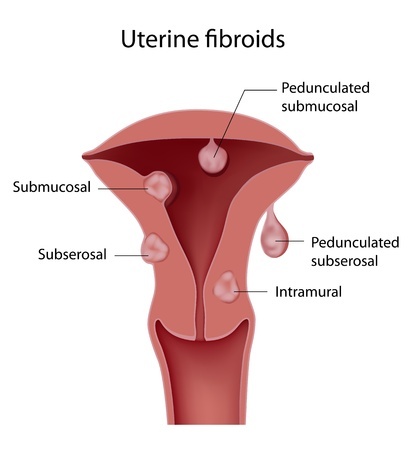 Uterine Cancer