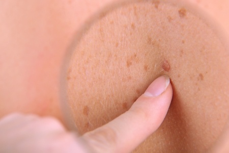 Viagra Melanoma Skin Cancer