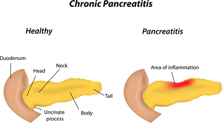 Viberzi Pancreatitis