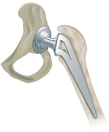 Wright Medical Hip Replacement