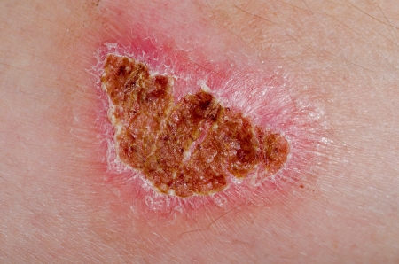 Zecuity Migraine Patch Burns & Scars