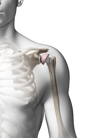 Zimmer Biomet Shoulder Replacement Class Action