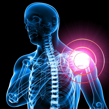 Zimmer Biomet Shoulder Replacement Lawsuit