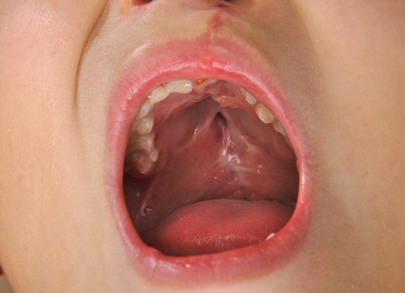 Zofran Cleft Palate