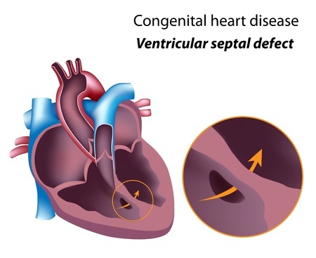 Zofran Ventricular Septal Defect