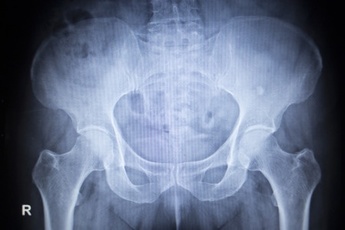 hip replacement lawsuits