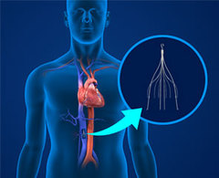 IVC Filter Lawsuit