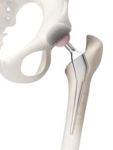 omni apex k2 hip implant recall