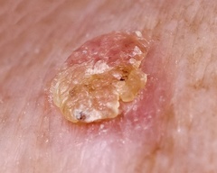 picato gel actinic keratosis