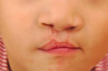 zofran cleft lip